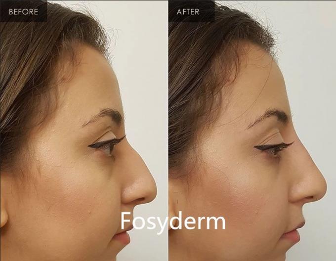 Fosyderm 2ml الوجه استخدام حمض الهيالورونيك حقن الحشو الجلدي لمكافحة الشيخوخة